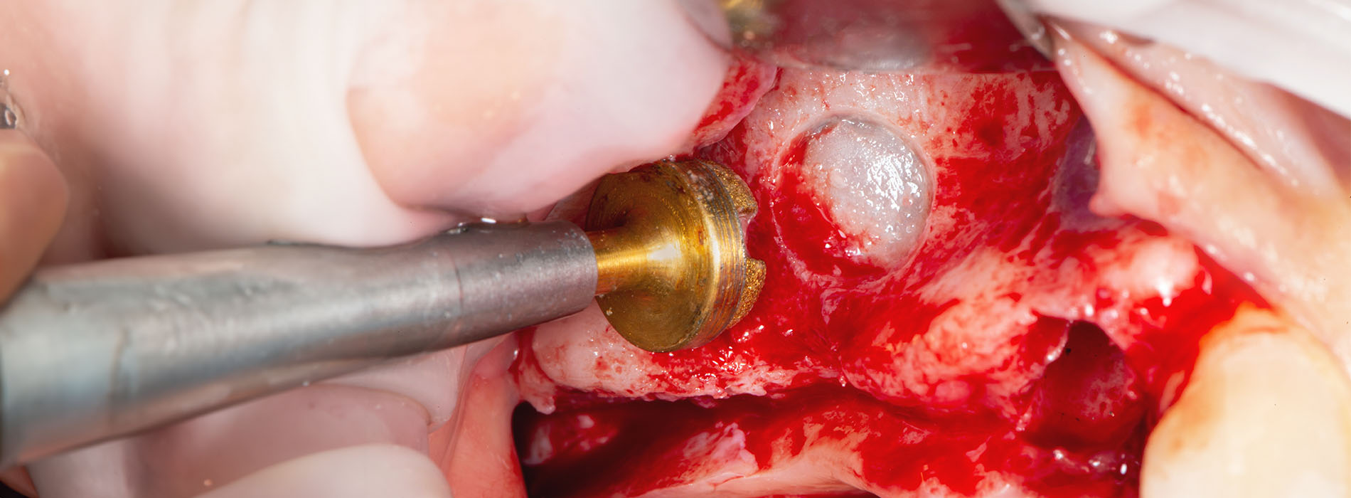 North Georgia Oral and Facial Surgery | Management of Maxillofacial Infections, Sinus Lift and Oral Pathology